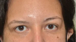 Skin Tag Removal London