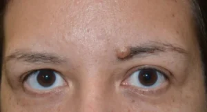 Skin Tag Removal london