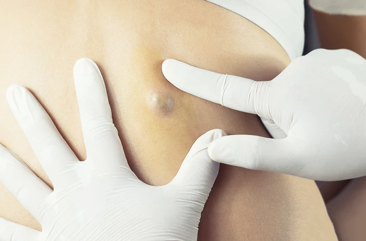 Sebaceous Cyst Removal