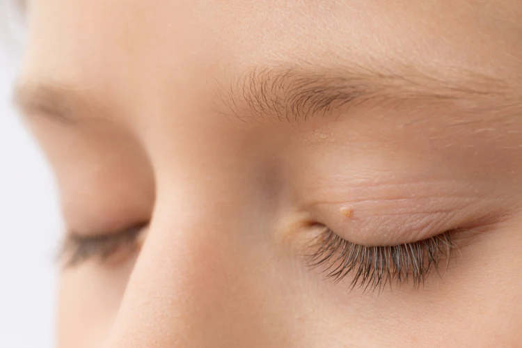 Skin Tag Removal London