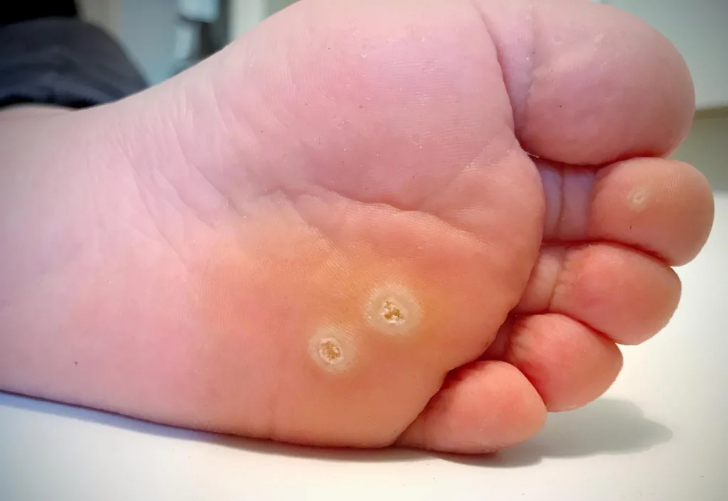 Verruca Plantar Warts Removal