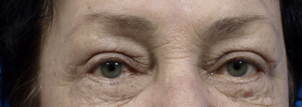 Blepharoplasty Eyelid Reduction Procedure London