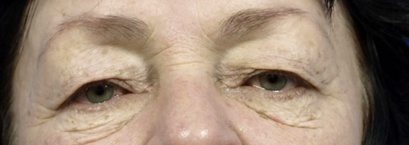 Blepharoplasty Eyelid Reduction Procedure London